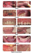 Boîte 20 pansements intra oraux MATBEKA de la marque ORA AID (25x15mm) - Safe Implant